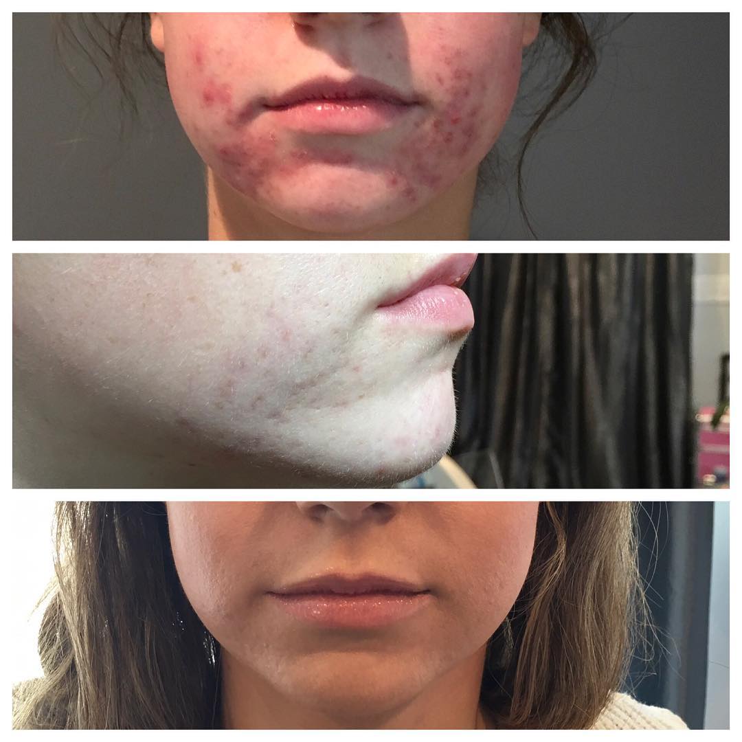 Acne treatments before and after results