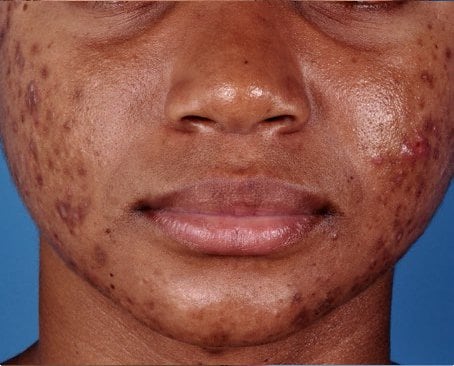 Before acne treatment