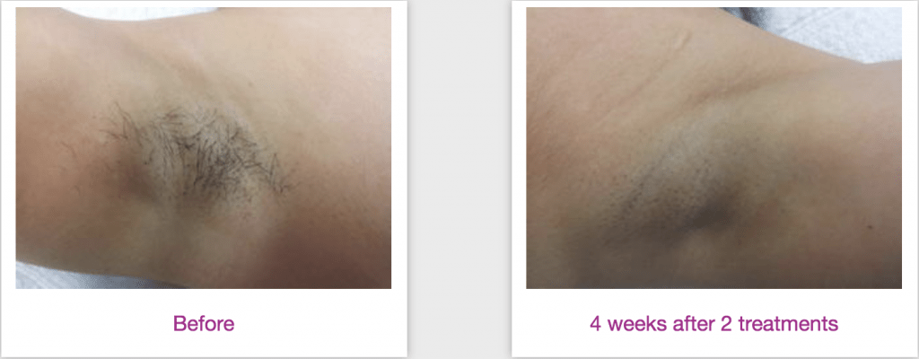 Before and after laser hair removal