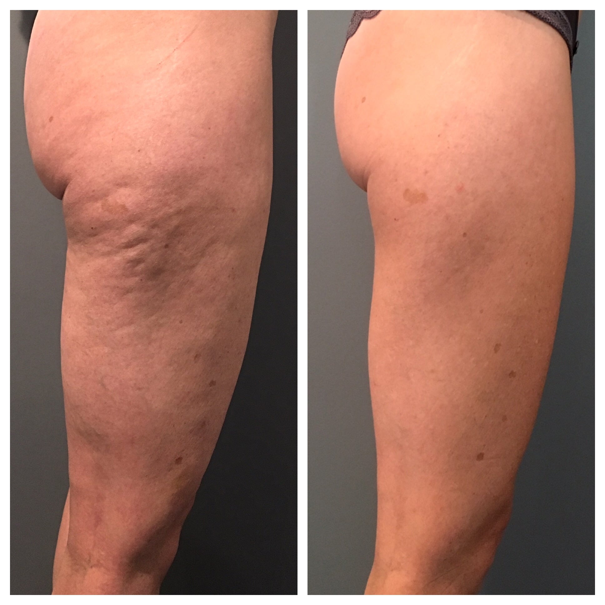 Before and after cellulite treatments