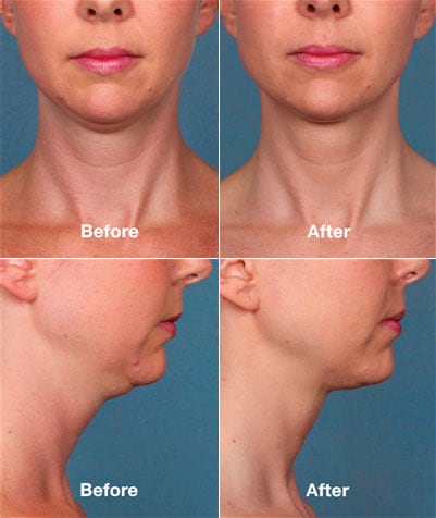 KYBELLA before and after