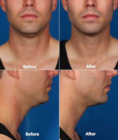 KYBELLA before and after #2
