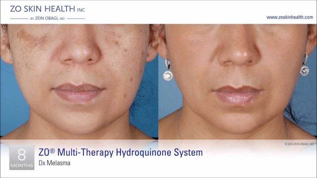 Before and after melasma treatments