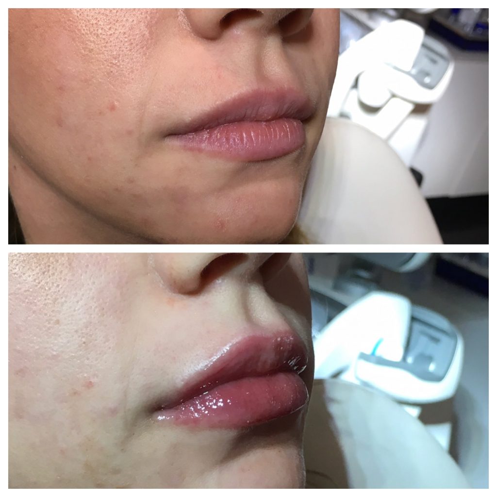 Before and after lip augmentation