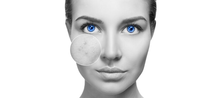 Acne Treatment Plans