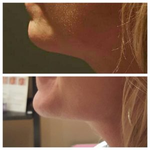 Before and after Kybella photos