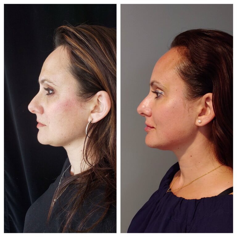 Profound Skin Tightening