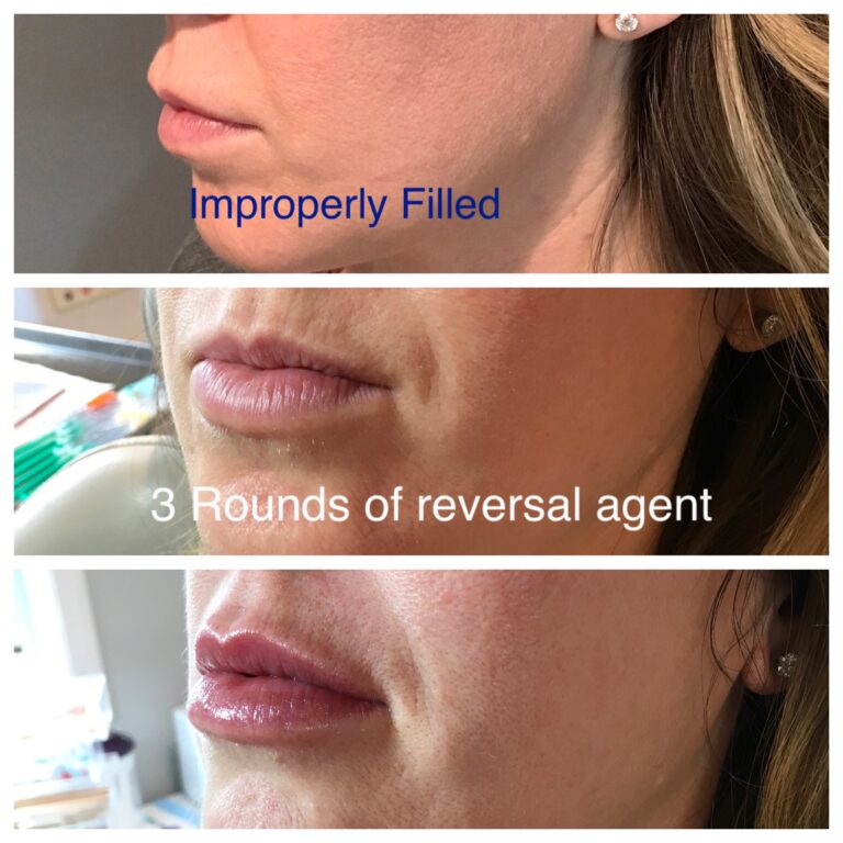 Profound Skin Tightening
