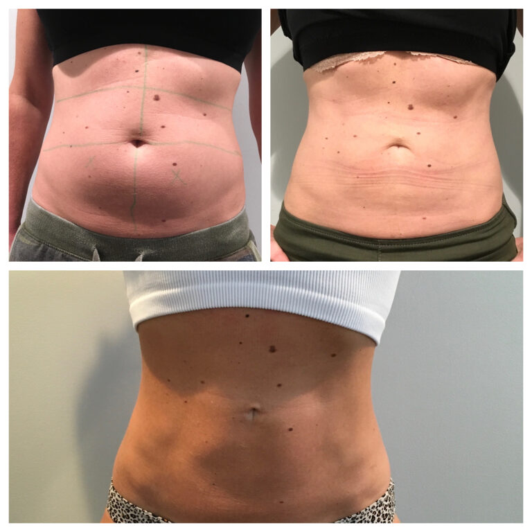CoolSculpting for stubborn fat