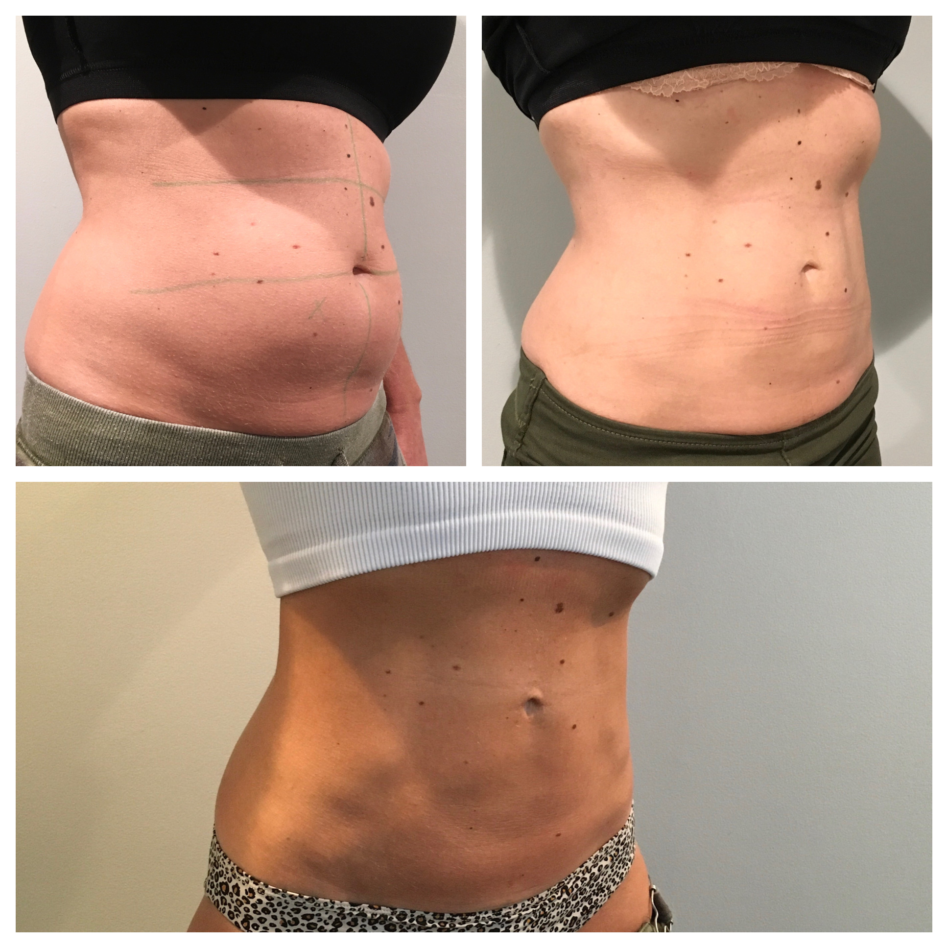 Does CoolSculpting Work?