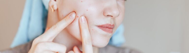 Acne Treatment Plans | Seacoast NH, North Shore MA | Dccm