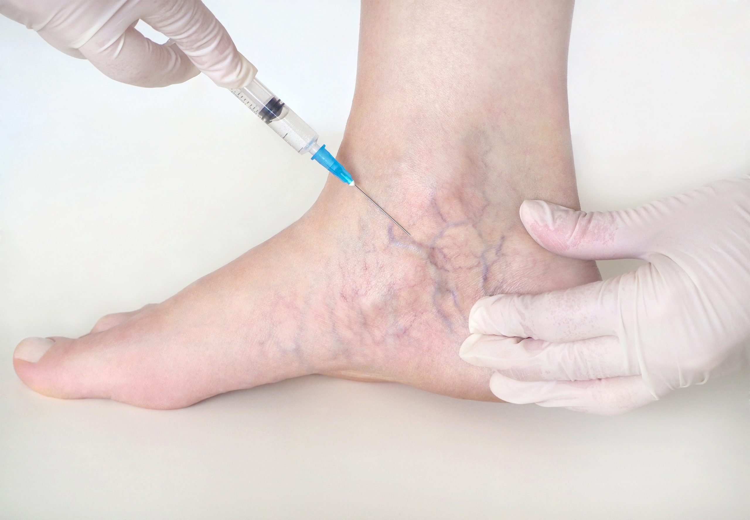 Possible Side Effects of Sclerotherapy You Should Know