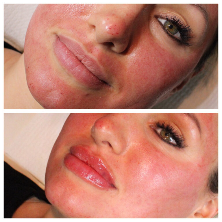 Lip Fillers | Seacoast NH, North Shore MA | Dccm