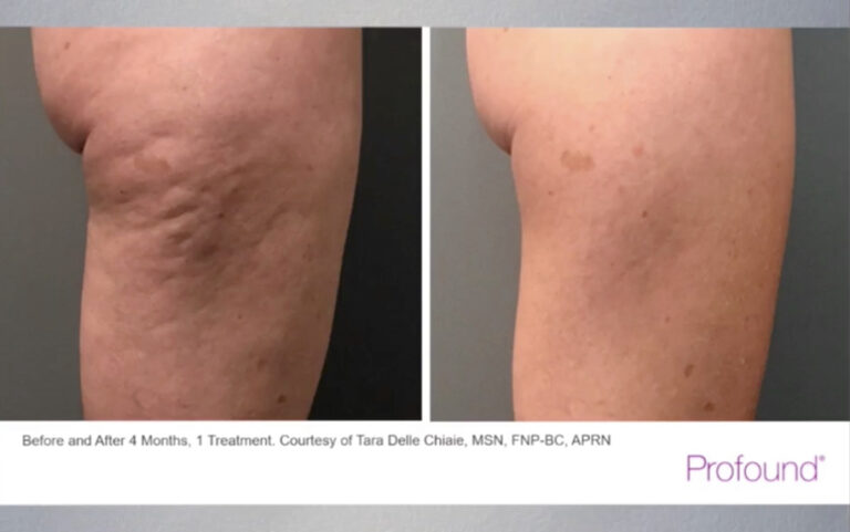 Everything You Need To Know About Cellulite Reduction with RF
