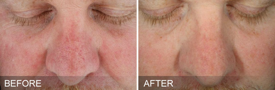 Hydrafacial Before and After 2