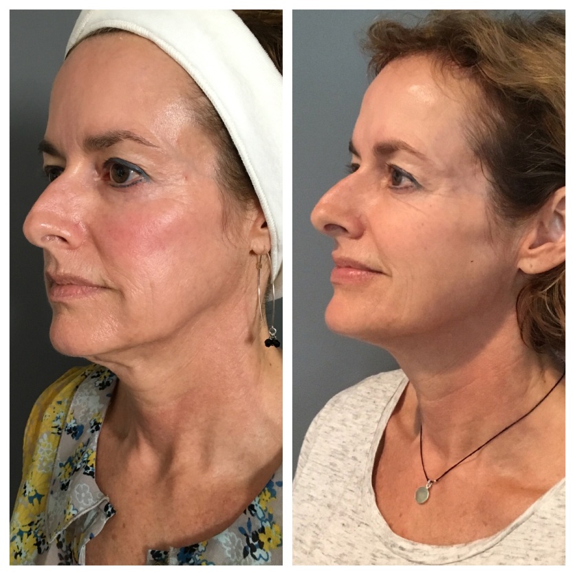 Skin Tightening Profound-RF-one Before & After 3